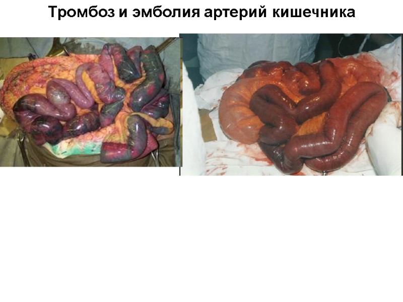 Тромбоз и эмболия артерий кишечника